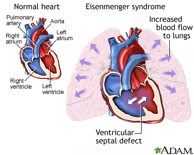 Eisenmenger syndrome