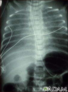 Totally anomalous pulmonary venous return, X-ray