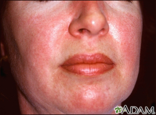 Dermatomyositis, heliotrope rash on the face
