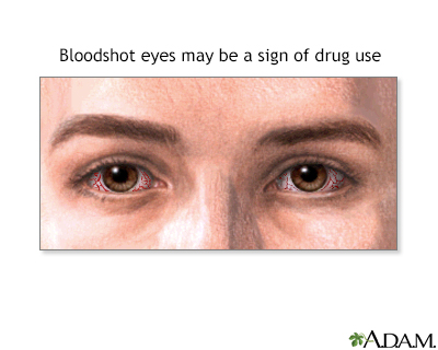 Signs of drug abuse