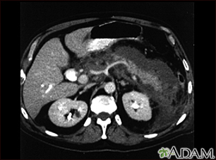 Pancreatitis aguda; TC