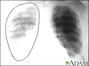 Ruptura aórtica, radiografía de tórax
