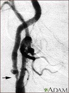 Estenosis carotídea; radiografía de la arteria derecha