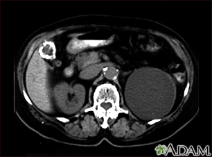 Quiste renal con cálculos biliares; TC