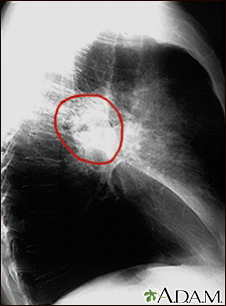 Cáncer de pulmón, radiografía lateral del tórax