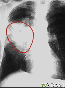 Cáncer de pulmón, radiografía frontal del tórax
