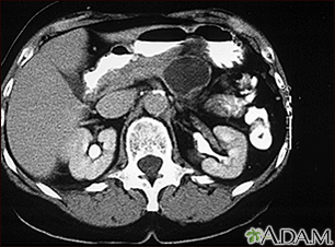 Adenoma quístico del páncreas; TC