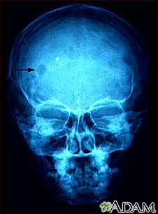 Granuloma eosinofílico- Radiografía del cráneo