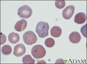 Malaria, vista microscópica de parásitos celulares