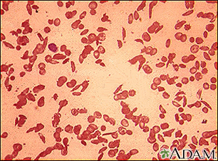 Glóbulos rojos drepanocíticos