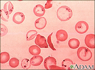 Glóbulos rojos: falciformes y cuerpos de Pappenheimer