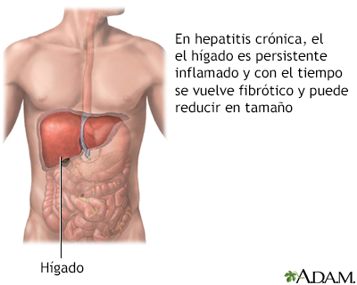 Hepatitis agresiva