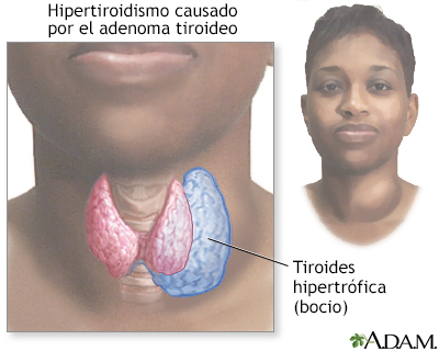 Hipertiroidismo