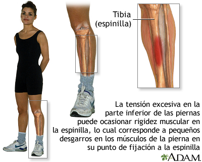 Shin splints