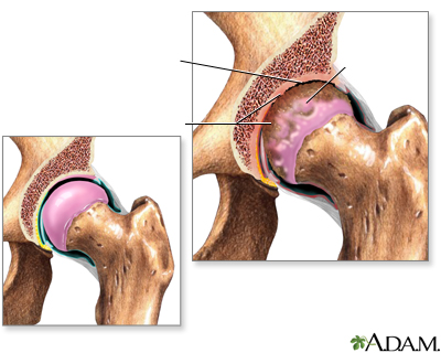 Arthritis in hip