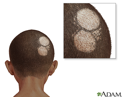 Ringworm of the scalp
