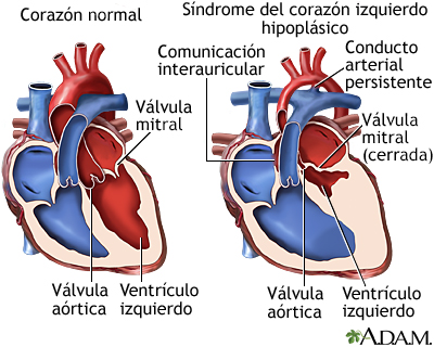 partes del corazon. Síndrome del corazón izquierdo