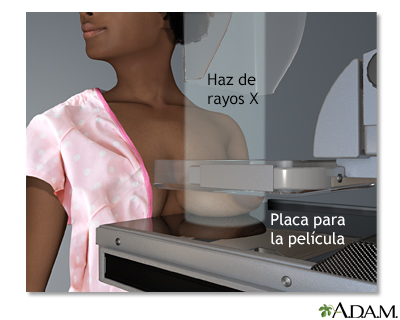 Mamografía