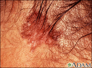 Cáncer de piel o carcinoma de célula basal pigmentado