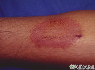 Dermatitis por contacto