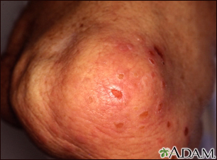 Dermatitis herpetiforme en la rodilla