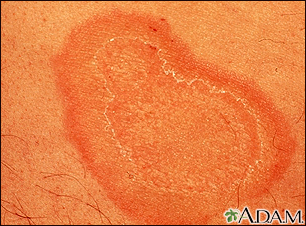 Eritema anular centrífugo-primer plano