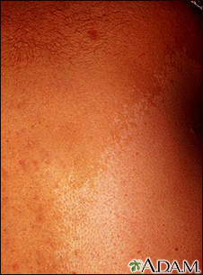 Neurofibromatosis, mancha gigante de color café con leche