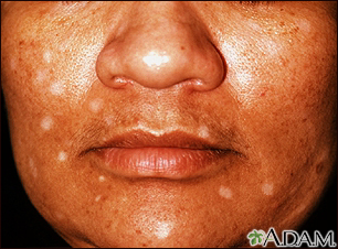 Vitiligo, inducido por medicamentos