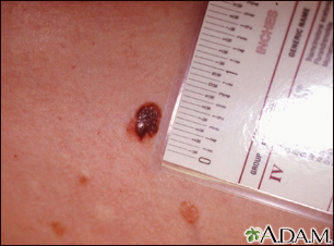 Cáncer de piel, primer plano del melanoma de nivel III