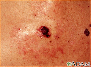 Cáncer de piel, primer plano del melanoma de nivel IV