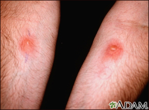 Examen de piel, PPD (brazo derecho) y Candida (izquierdo)