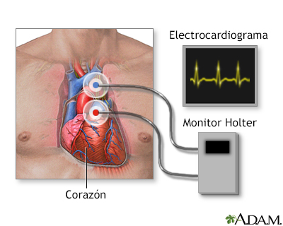 Monitoreo cardíaco Holter