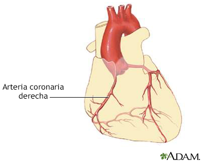 Enfermedad de las arterias coronarias