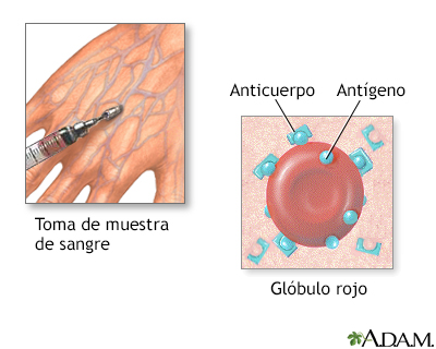 Biopsia de herpes